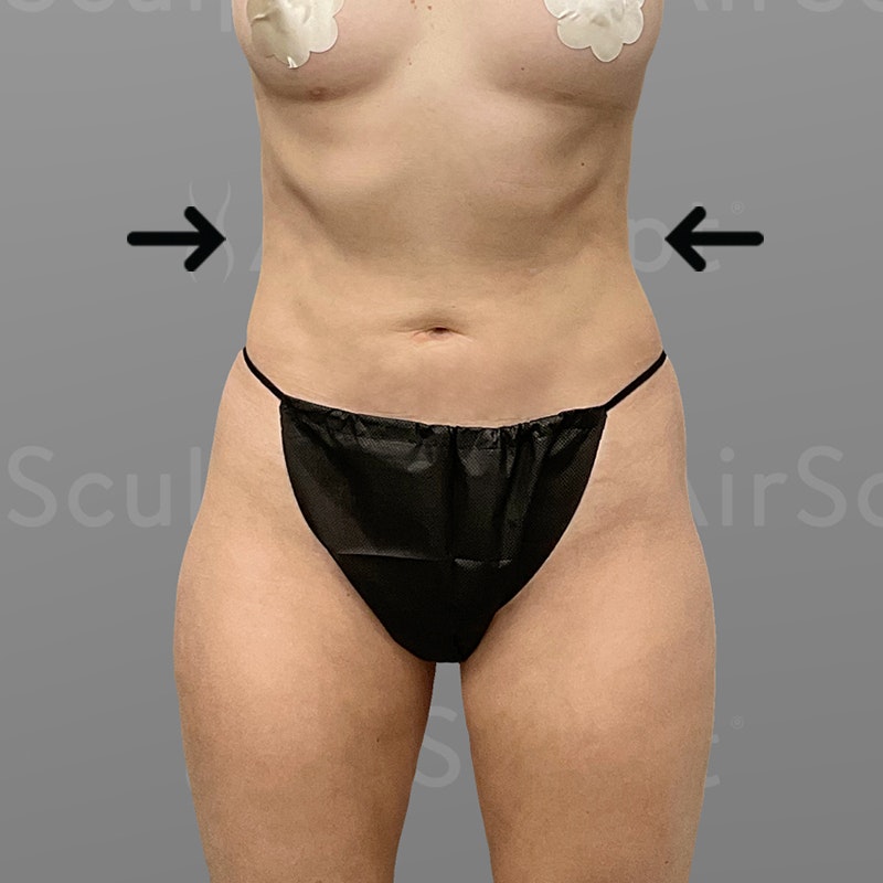 after stomach airsculpt+