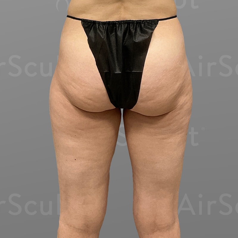 before inner thigh airsculpt +