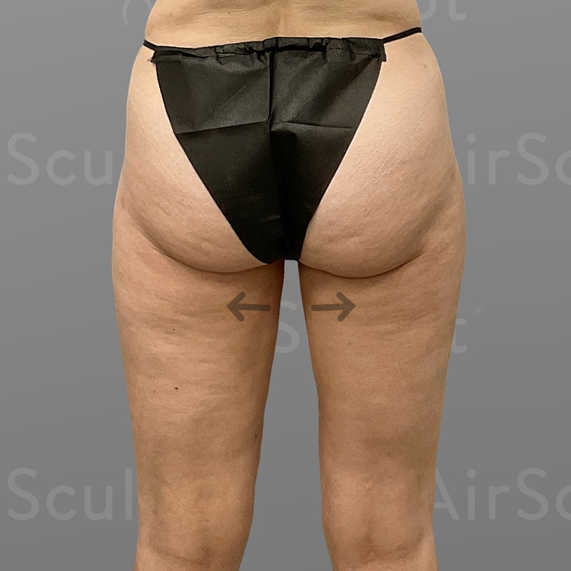 after inner thigh airsculpt +