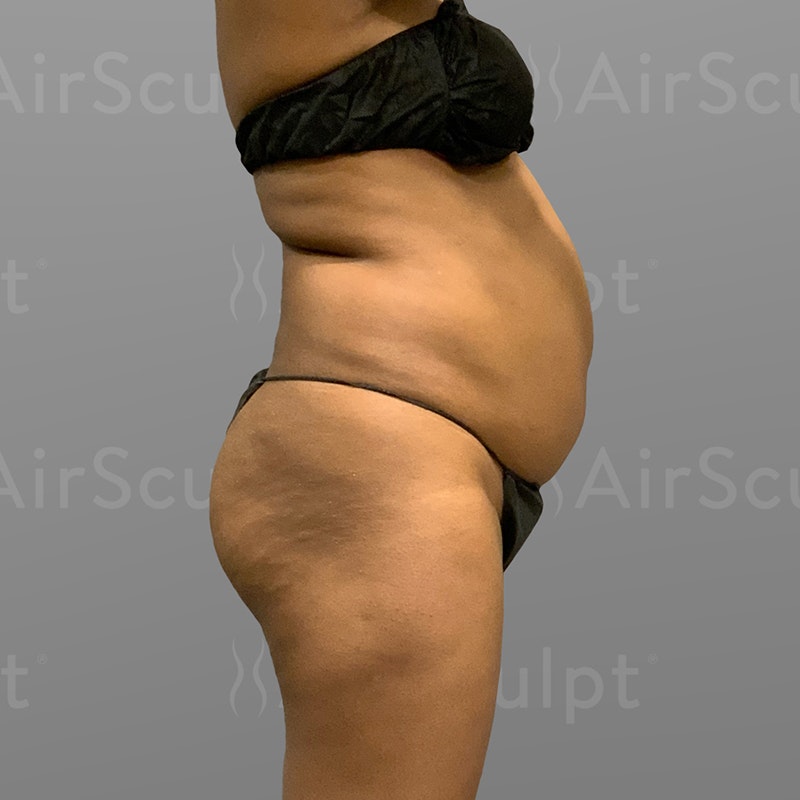 before stomach and BBL airsculpt