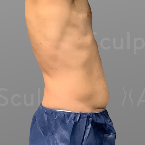 before 48 hour six pack lipo