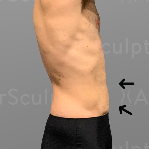 after 48 hour six pack lipo