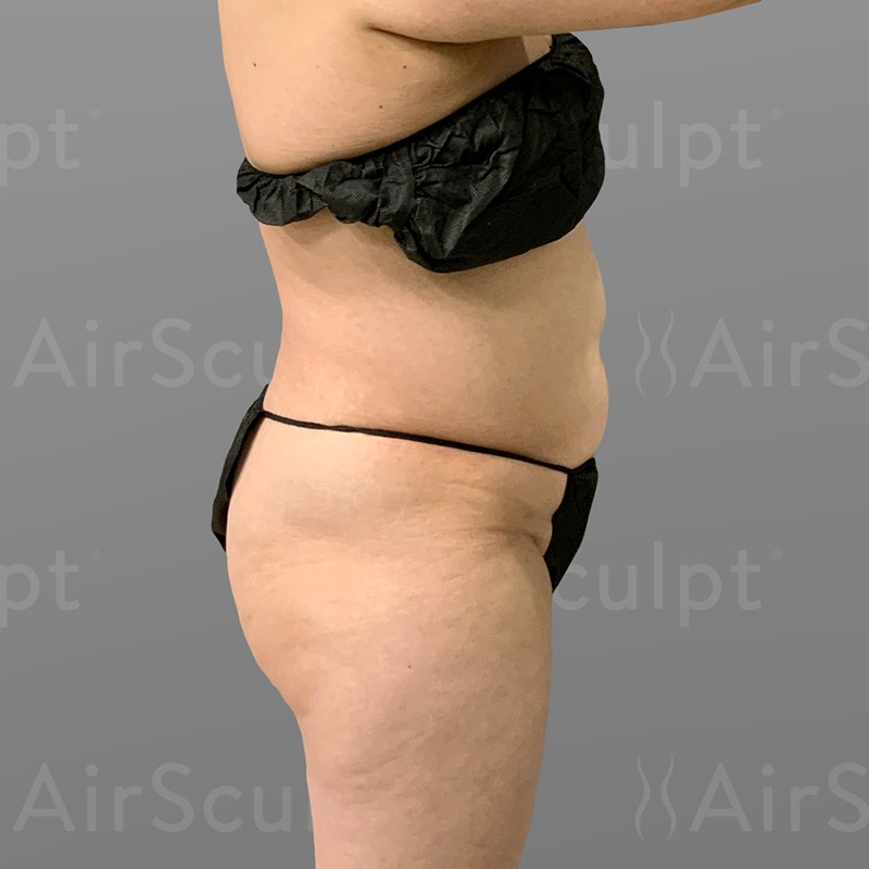 before lower back, stomach, BBL airsculpt
