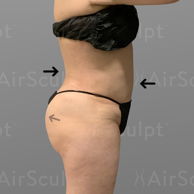 after lower back, stomach, BBL airsculpt