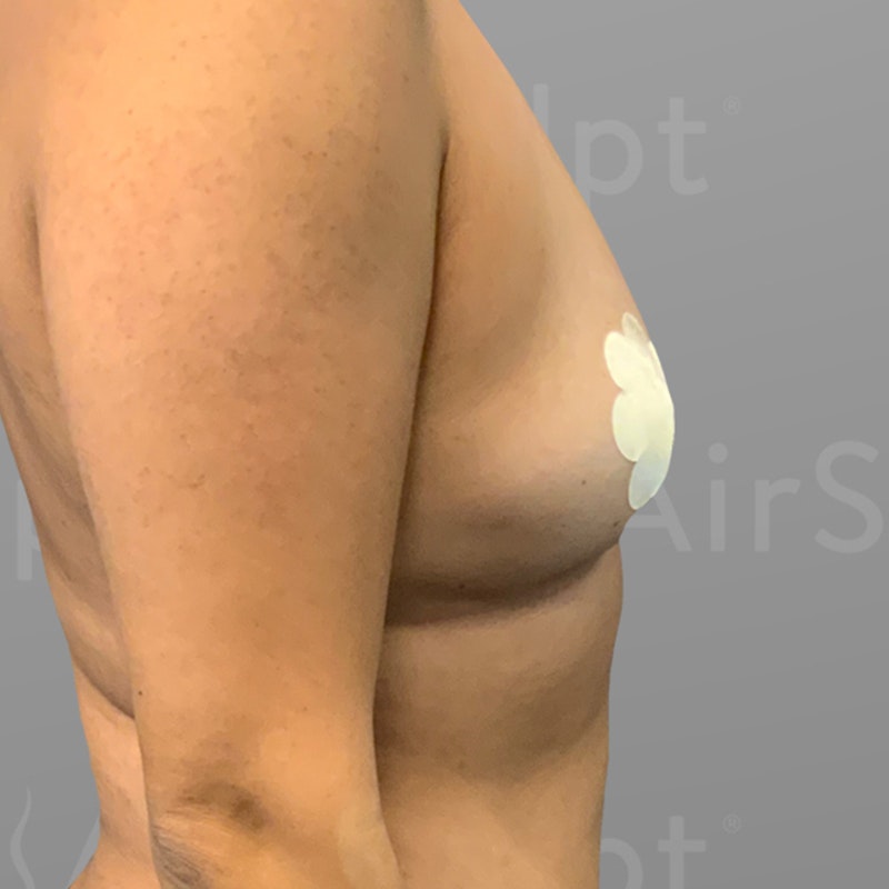 before fat transfer from stomach to breasts