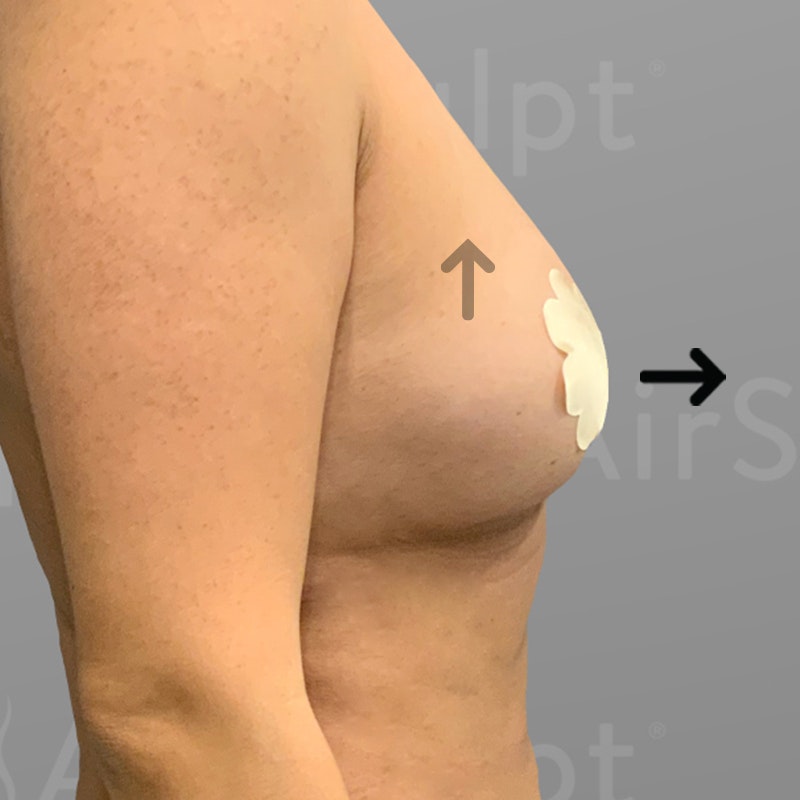 after fat transfer from stomach to breasts