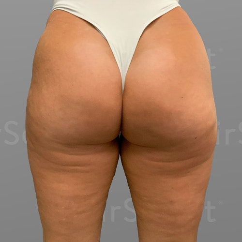 after AirSculpt Smooth