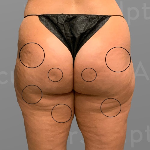 before AirSculpt Smooth