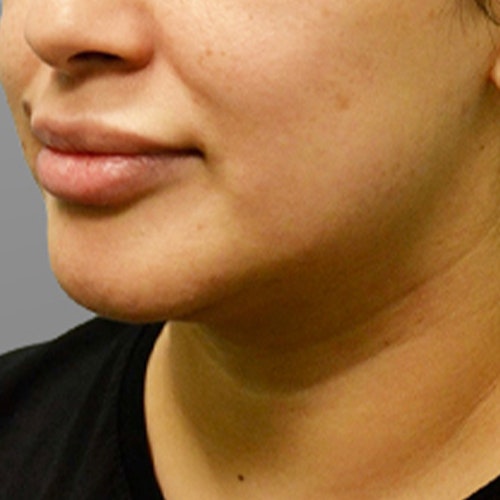 before chin airsculpt