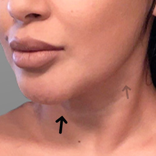 after chin airsculpt