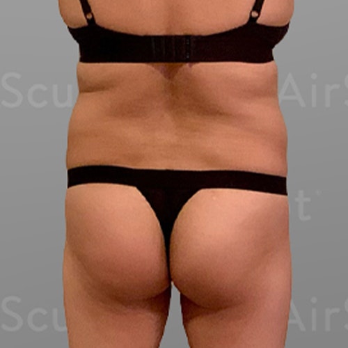 before stomach, back bra roll, Power BBL AirSculpt
