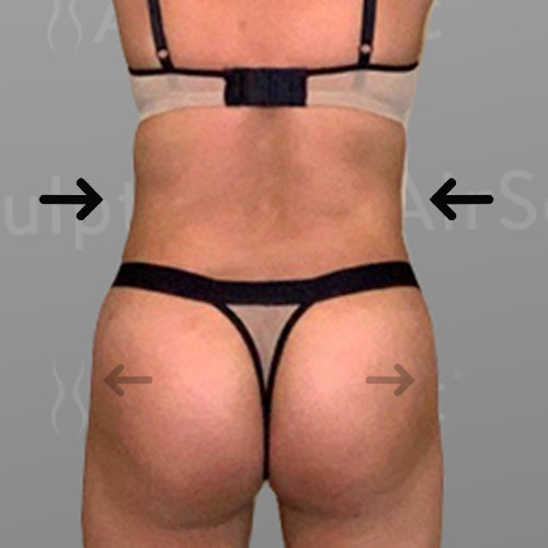 after stomach, back bra roll, Power BBL AirSculpt