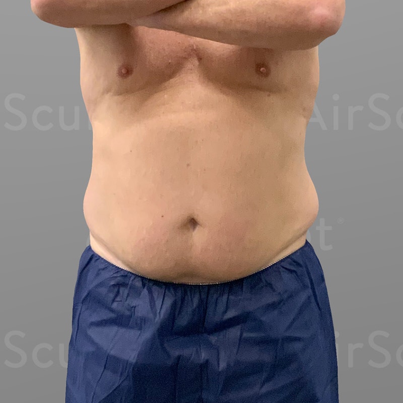 before 48 hour six pack lipo
