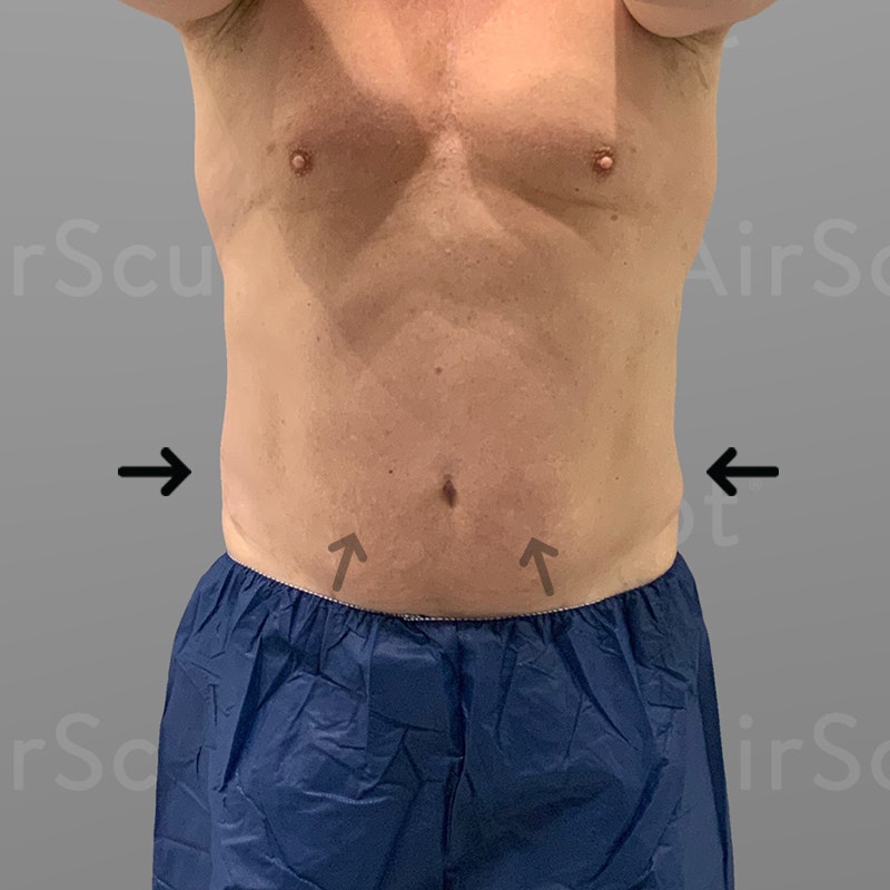 after 48 hour six pack lipo