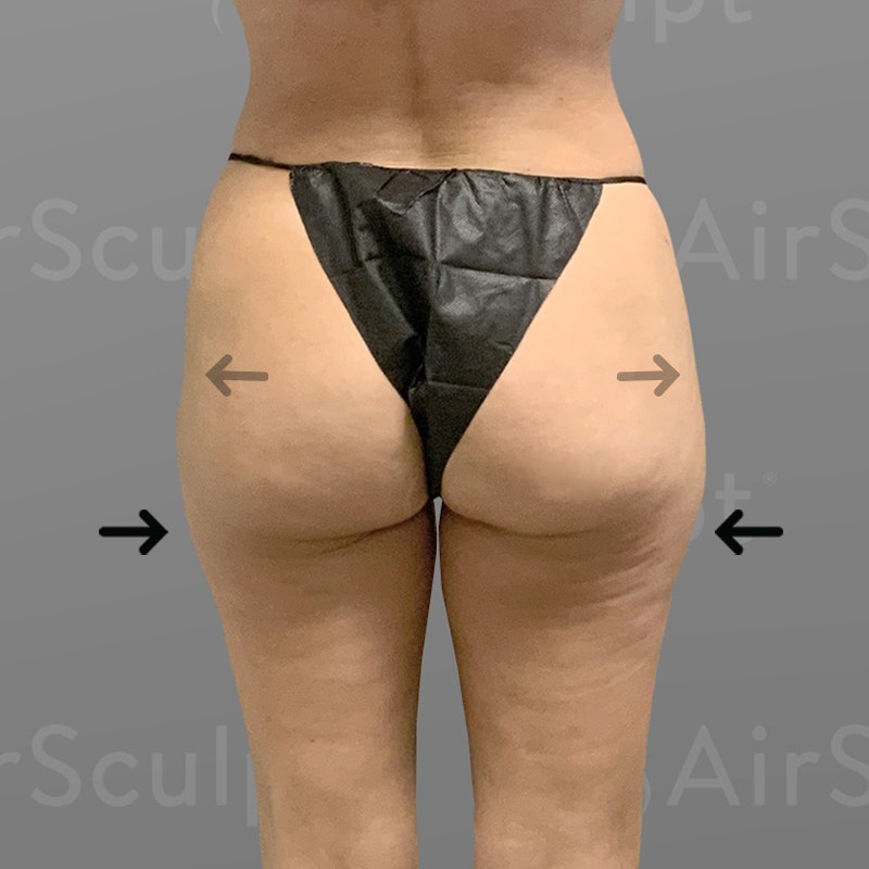 After Outer Thigh and Hip Flip AirSculpt