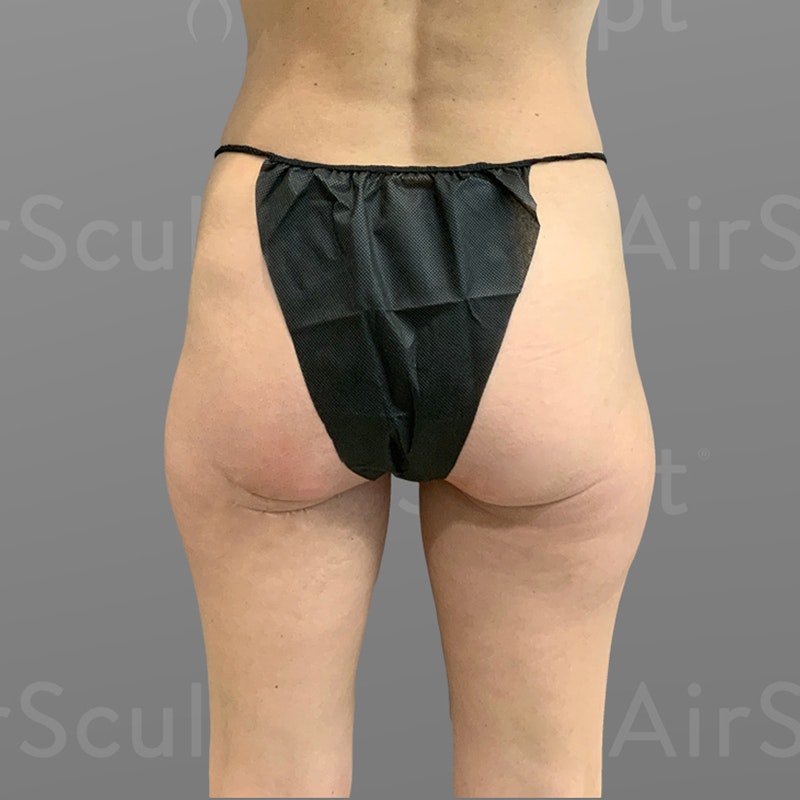 before outer thigh and hip flip airsculpt
