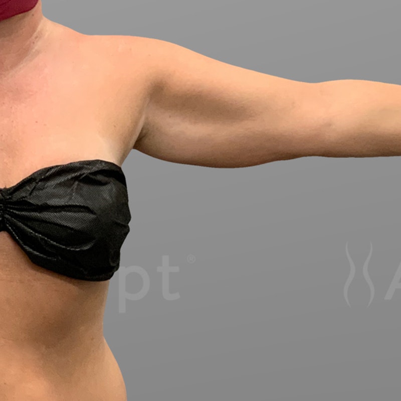 before arm airsculpt +