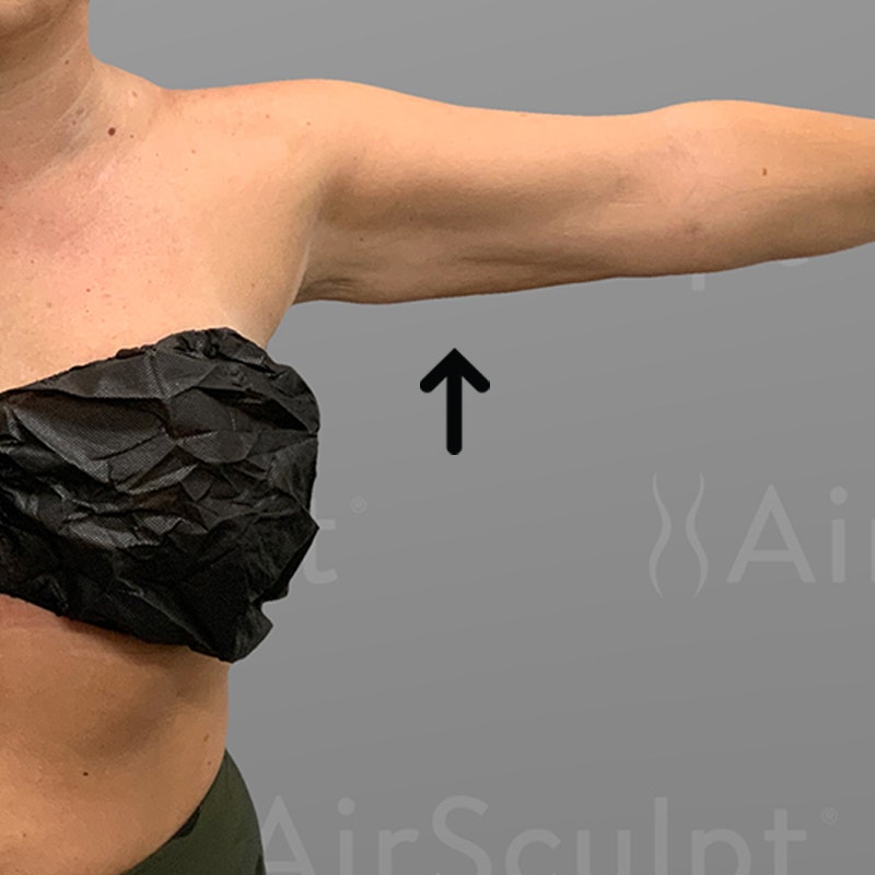 after arm airsculpt +