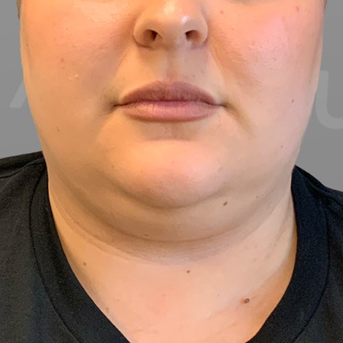 before chin airsculpt