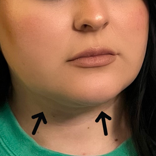 after chin airsculpt