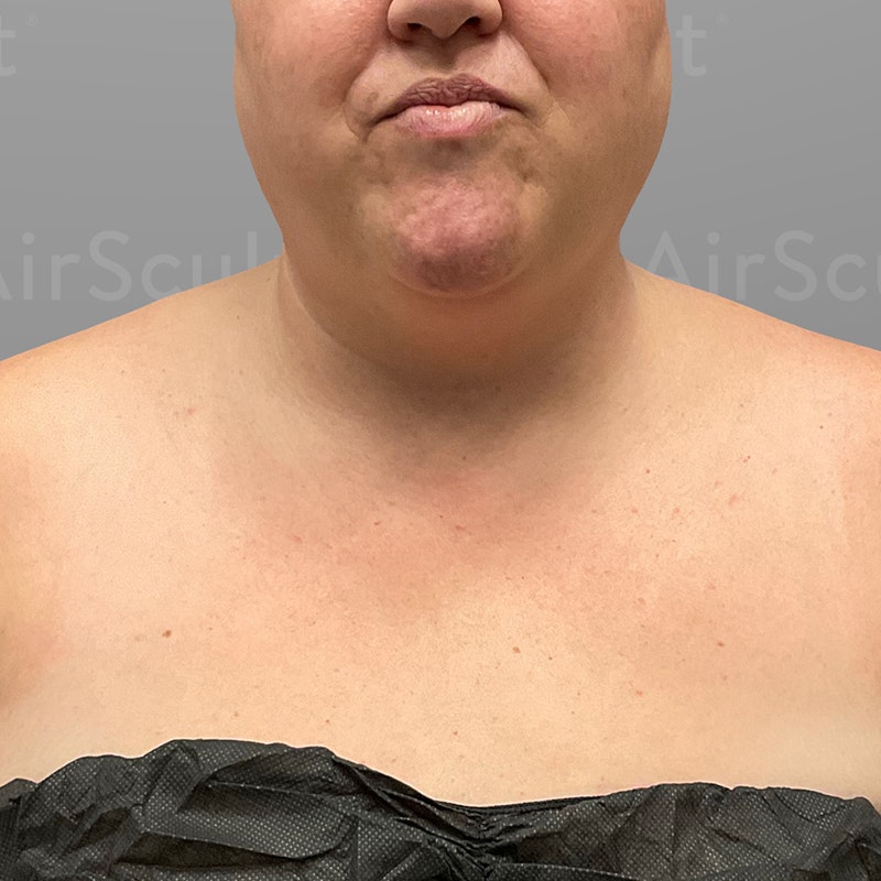 before chin airsculpt+