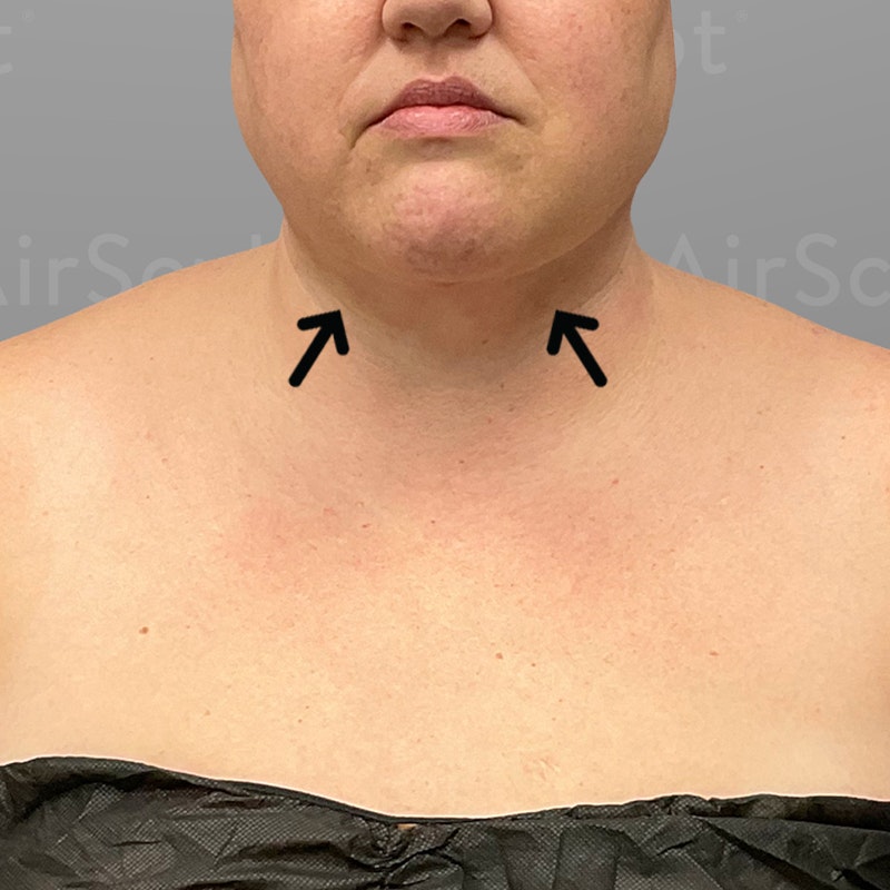 after chin airsculpt+