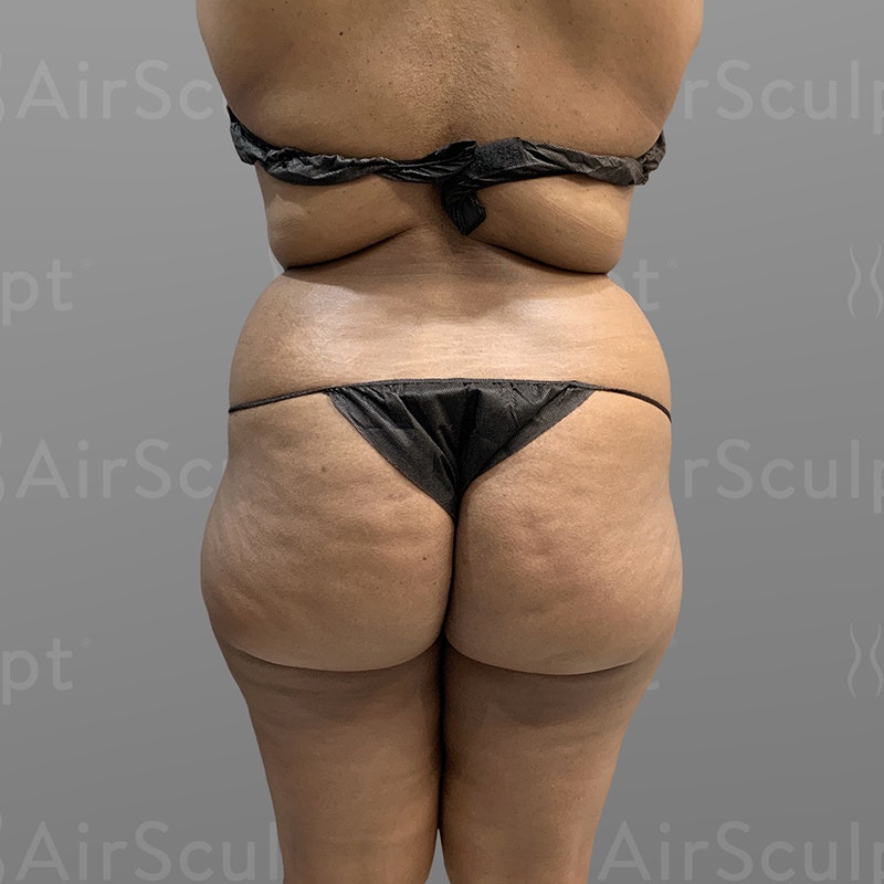 before stomach and back airsculpt