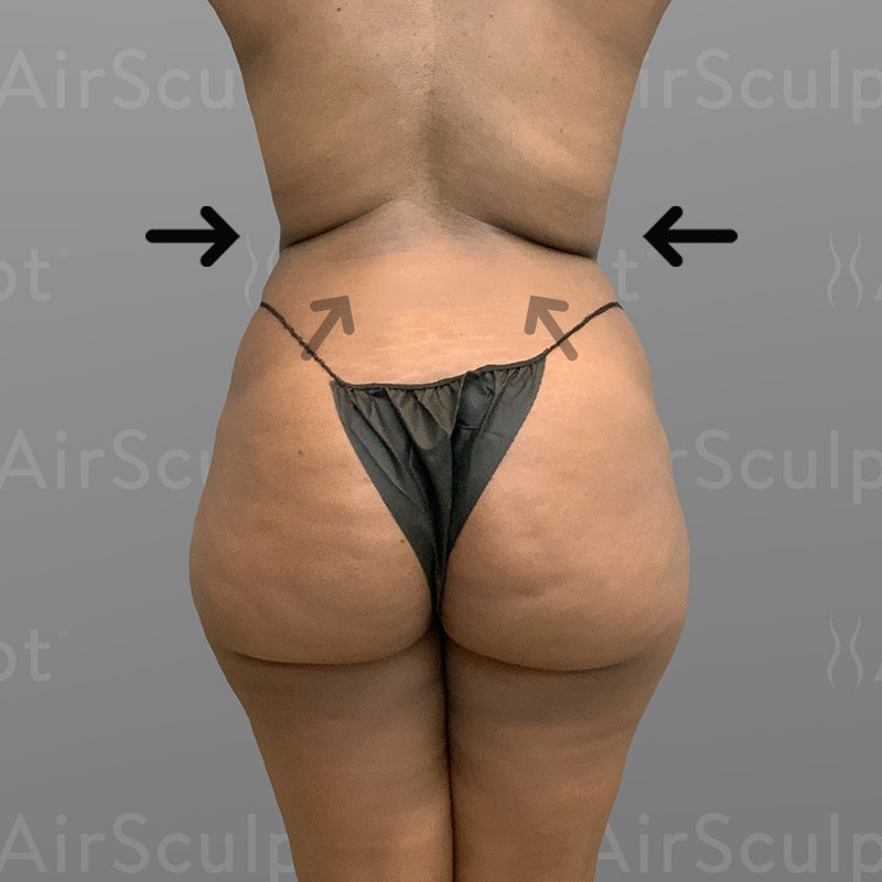after stomach and back airsculpt