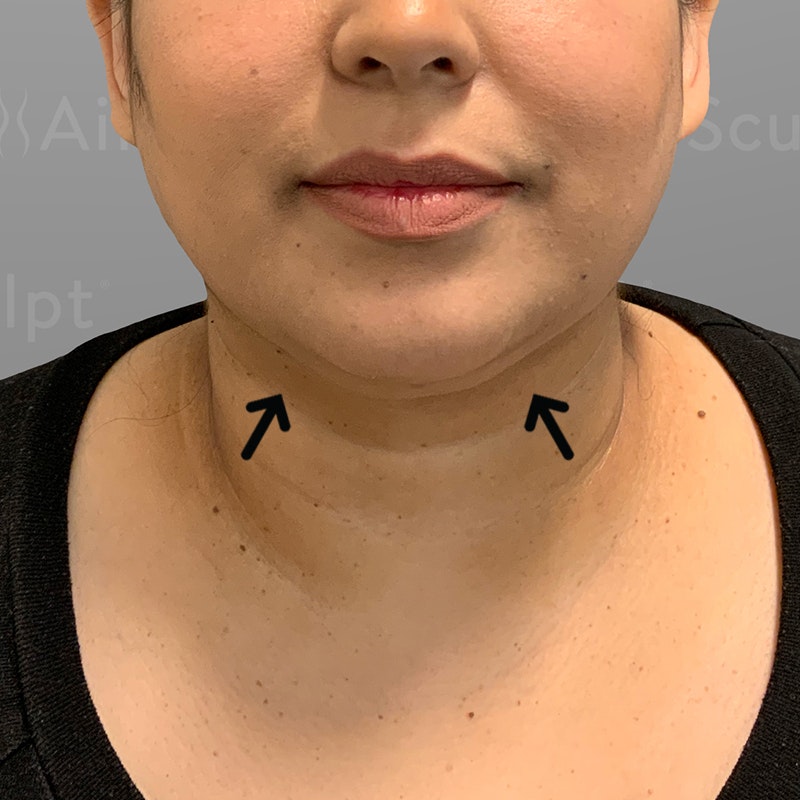after chin airsculpt