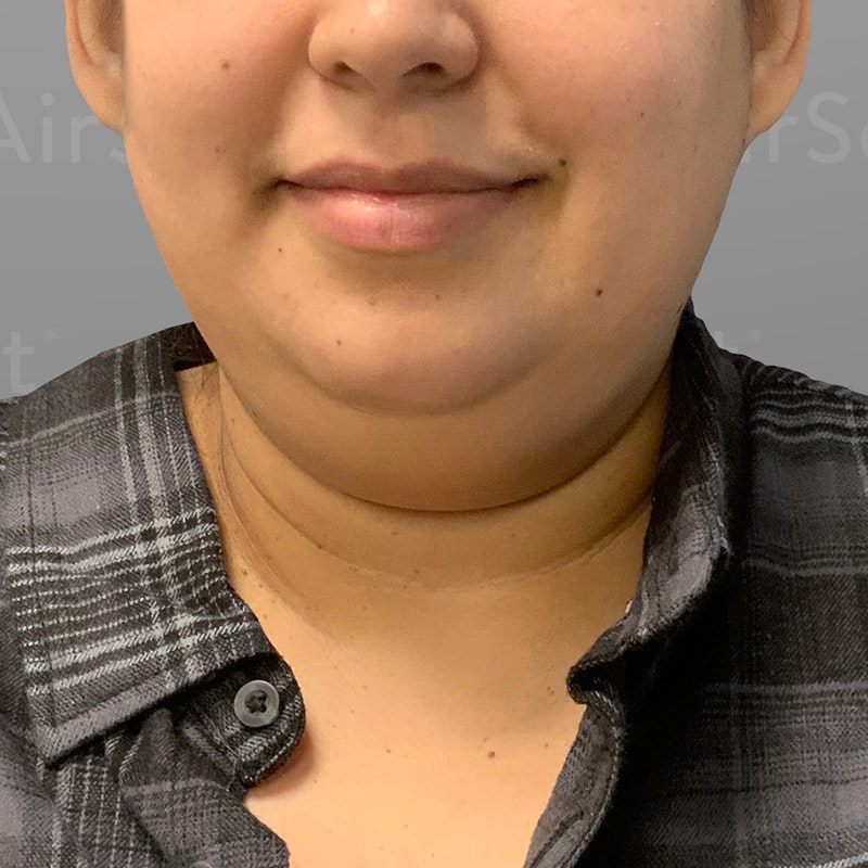 before chin airsculpt