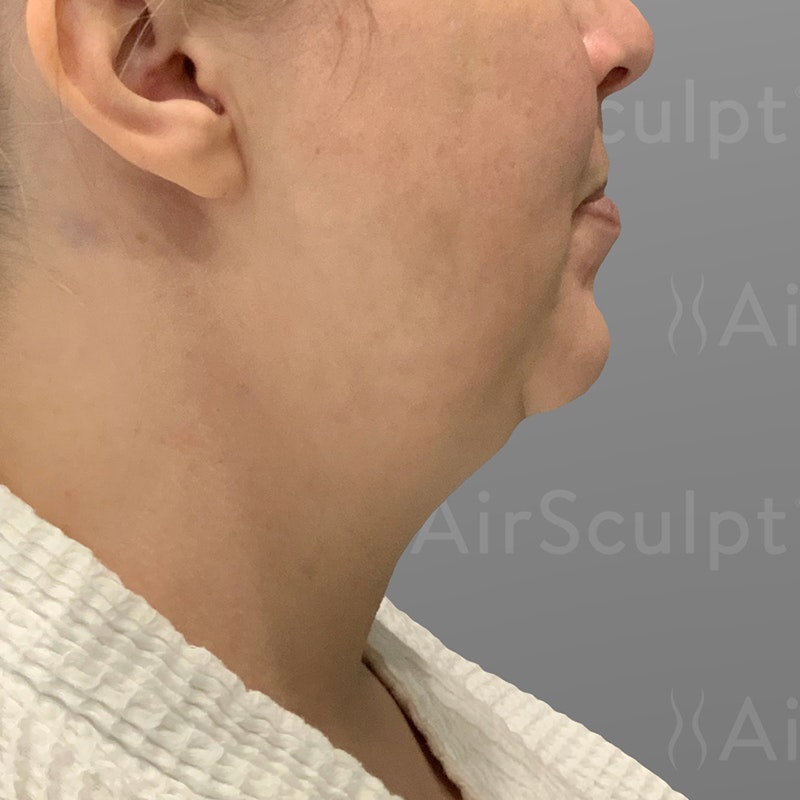 before chin airsculpt