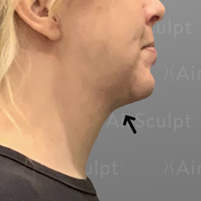 after chin airsculpt