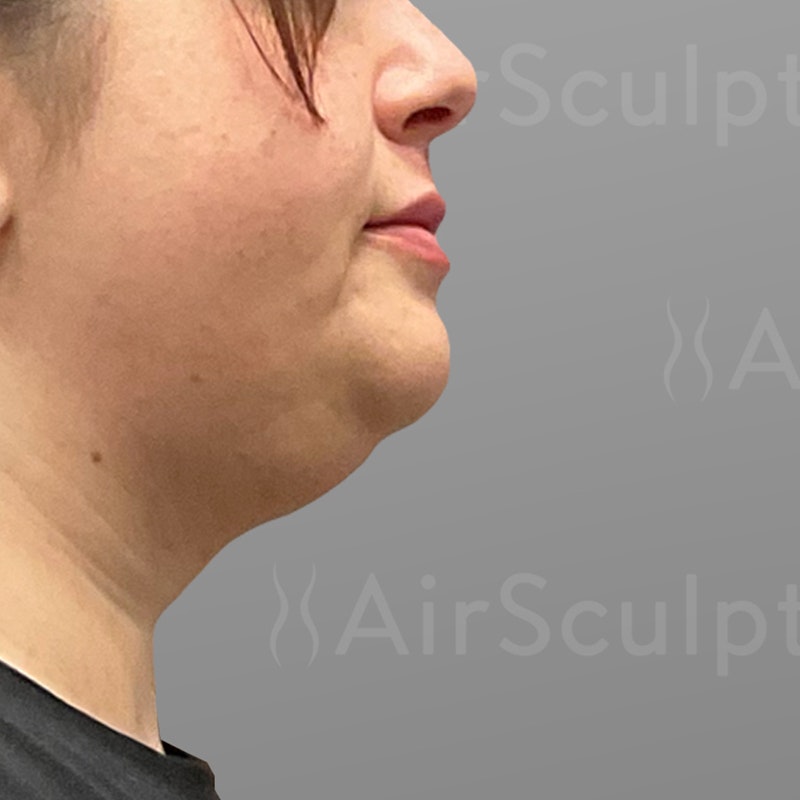 before chin airsculpt +