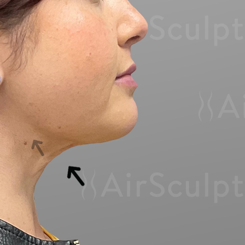 after chin airsculpt +