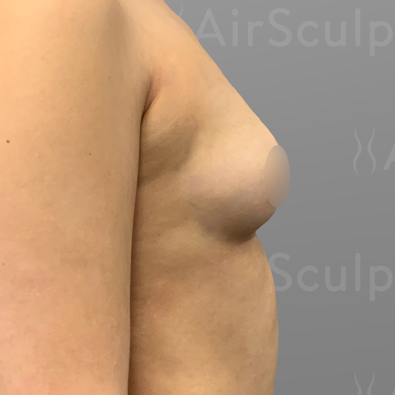 before Up a Cup breast enhancement