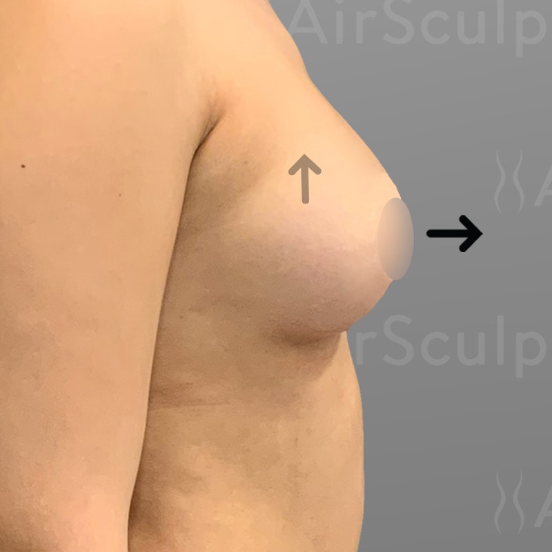 after Up a Cup breast enhancement