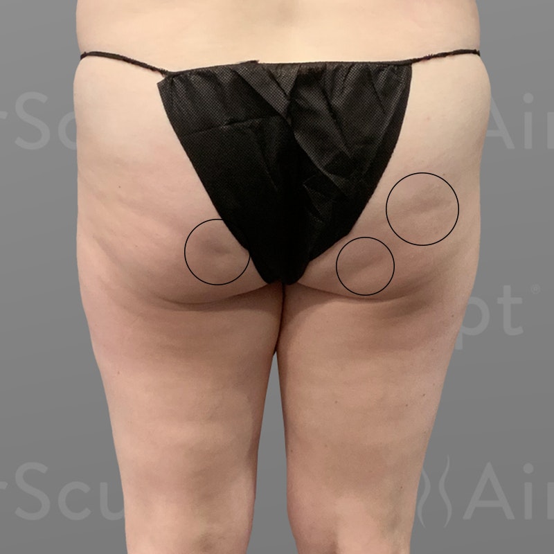 before AirSculpt® Smooth