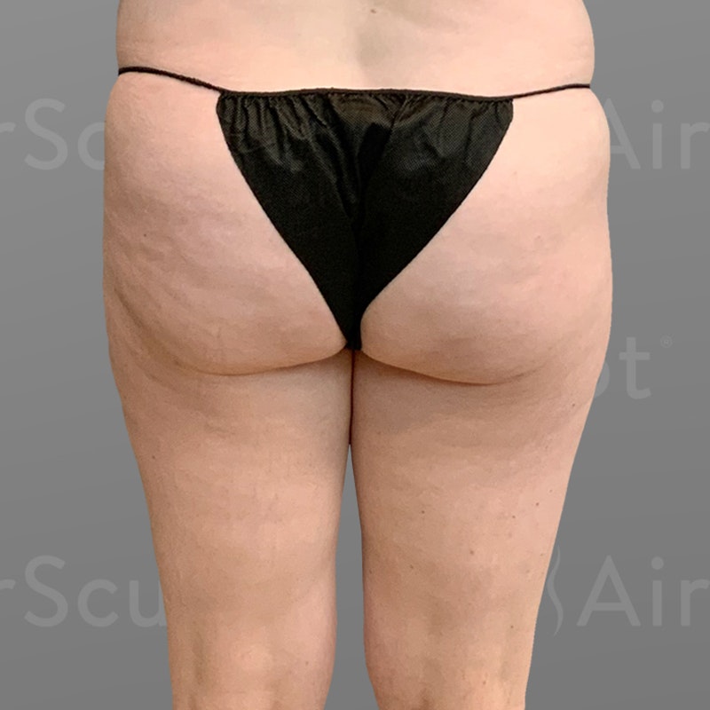 after AirSculpt® Smooth