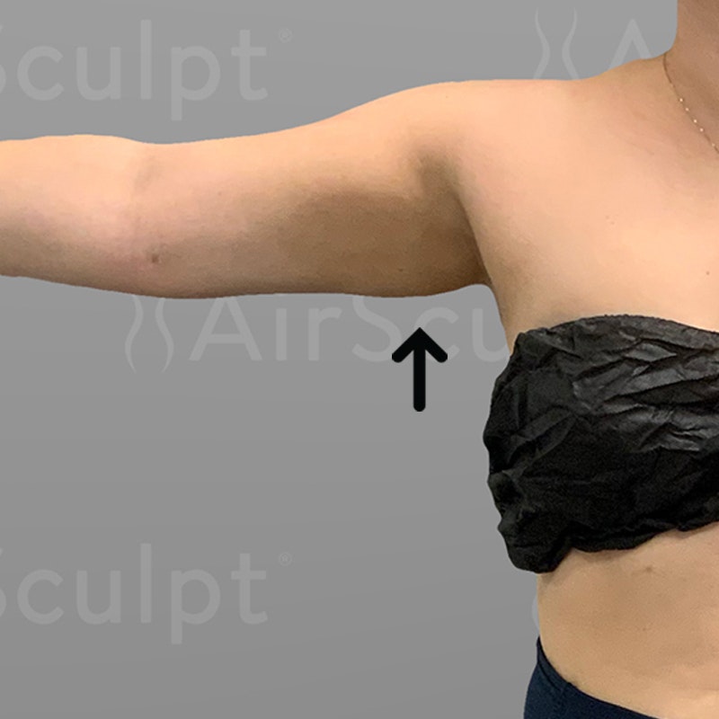 after arm airsculpt+