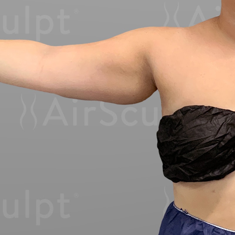 before arm airsculpt+
