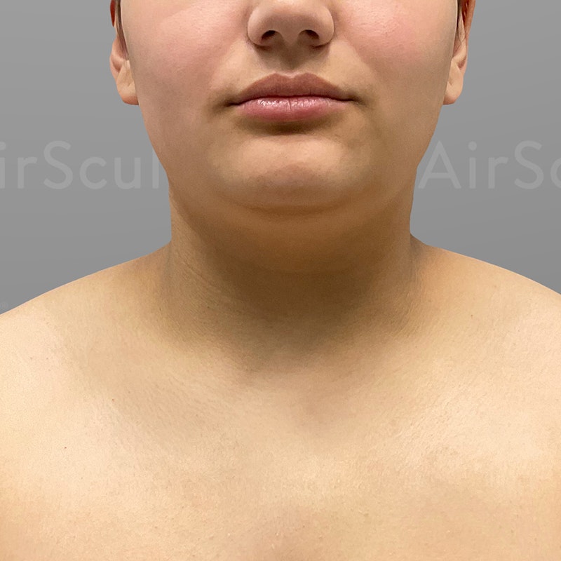 before airsculpt +