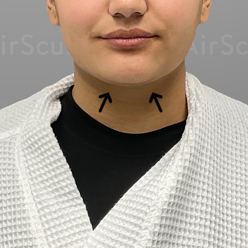 after chin airsculpt +