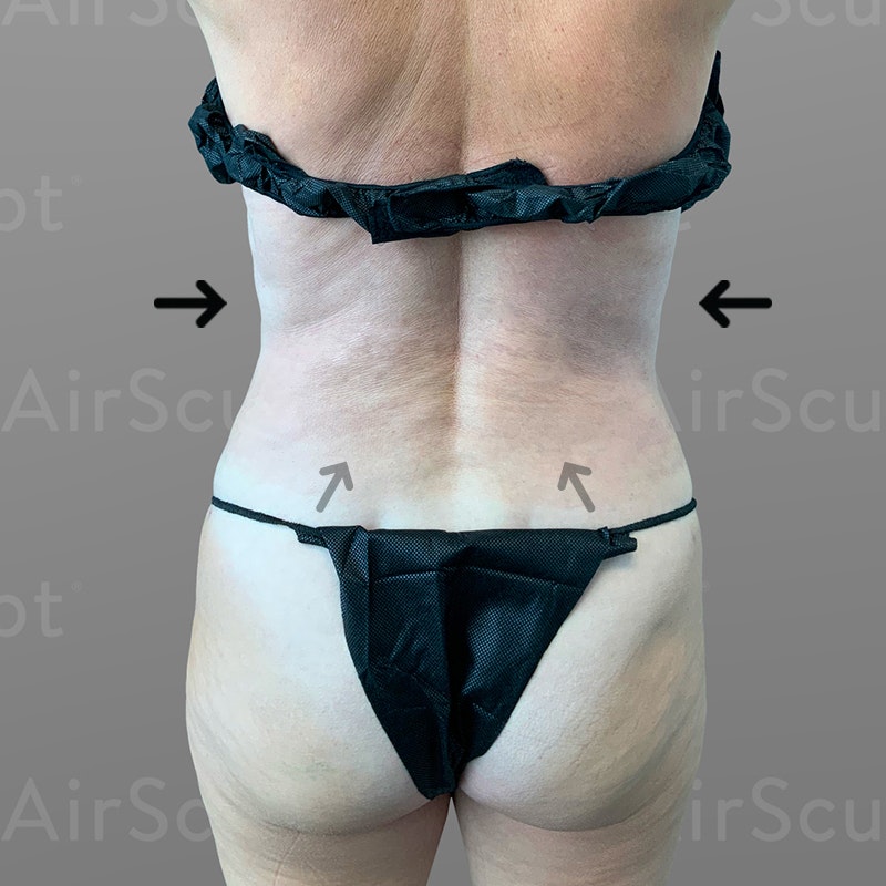 after stomach, pubic, and back bra roll airsculpt