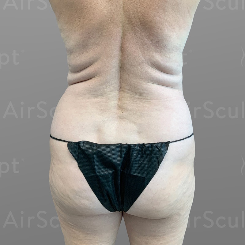 before stomach, pubic, and back bra roll airsculpt