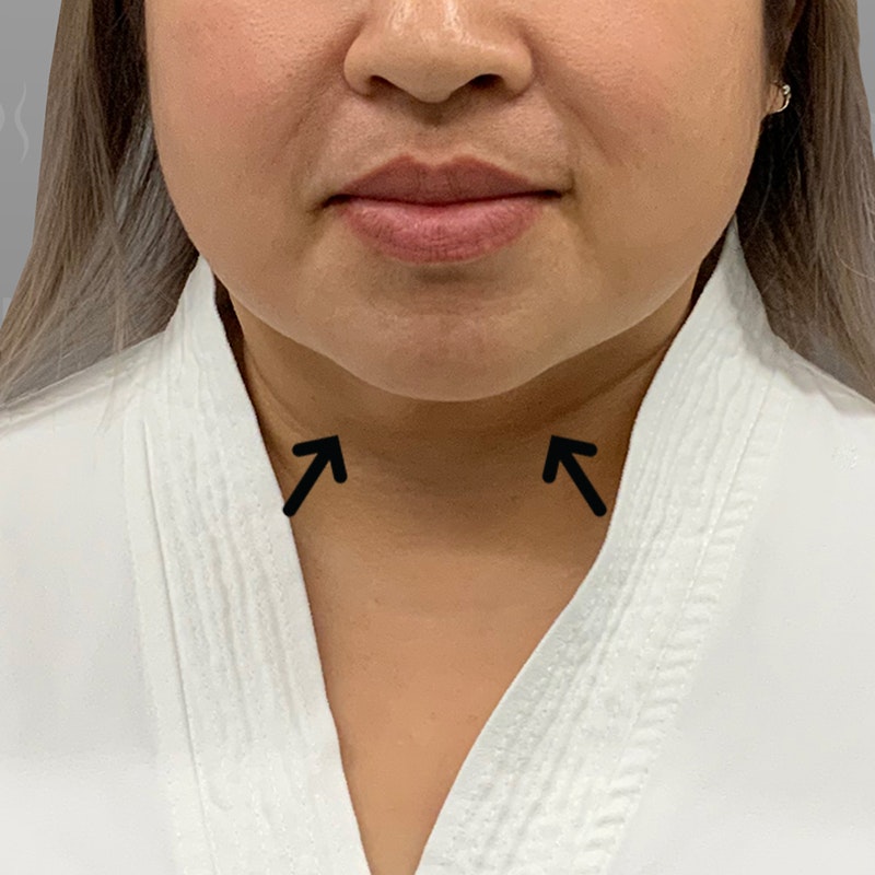 after chin airsculpt +