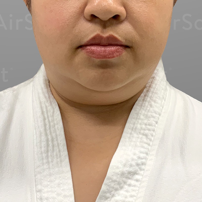 before chin airsculpt +