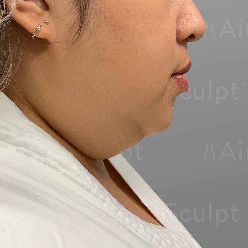 before chin airsculpt +