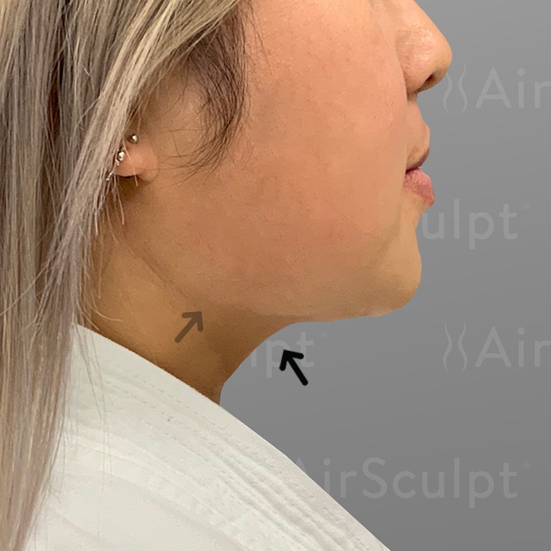 after chin airsculpt +