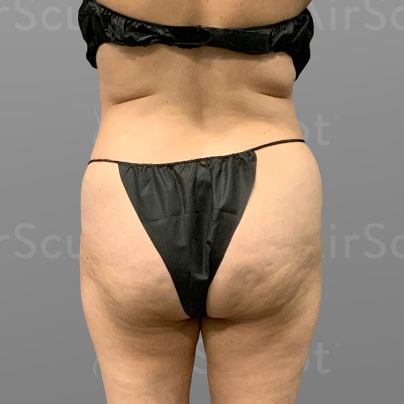 before Back Bra Roll, Lower Back, Full Ab, BBL AirSculpt
