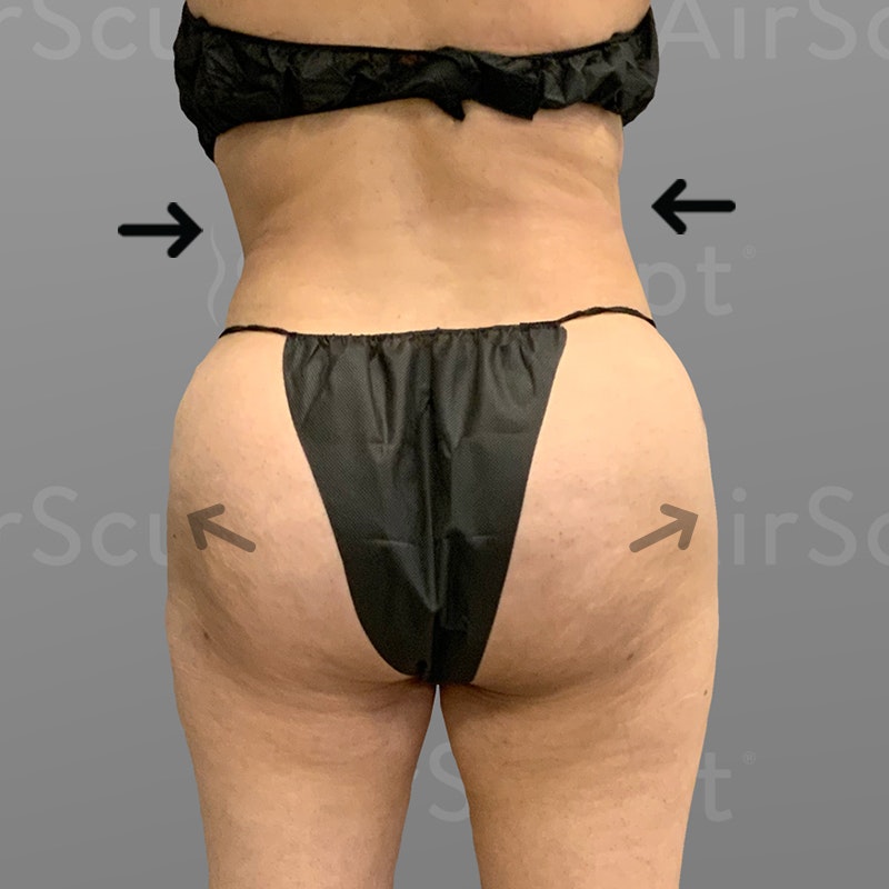 after Back Bra Roll, Lower Back, Full Ab, BBL AirSculpt